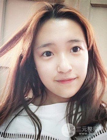 上海面部脂肪填充一個月果超明X、妥妥減齡十歲！