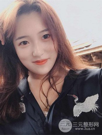 上海面部脂肪填充一個月果超明X、妥妥減齡十歲！