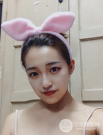 上海面部脂肪填充一個月果超明X、妥妥減齡十歲！