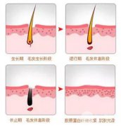 激光脫毛多久做一次