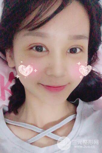 芭比電雙眼皮多項(xiàng)整形術(shù)后分享，雙眼皮拯救死魚眼！