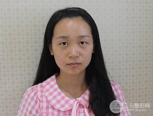 芭比電雙眼皮多項(xiàng)整形術(shù)后分享，雙眼皮拯救死魚眼！