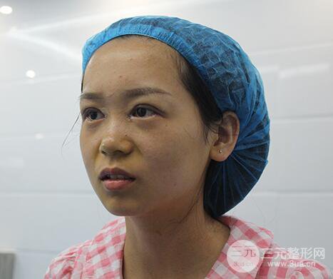 芭比電雙眼皮多項(xiàng)整形術(shù)后分享，雙眼皮拯救死魚眼！