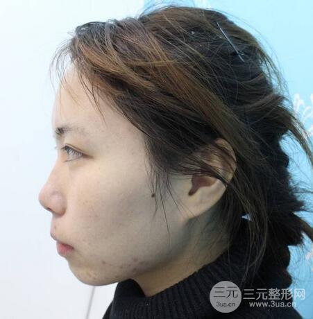 自體脂肪填充全臉基本換臉，改臉型不只是磨骨才能做到！