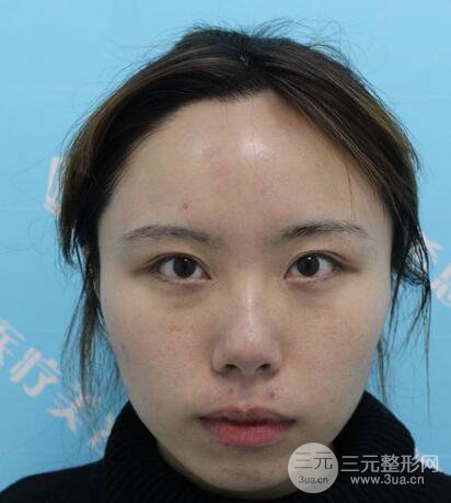 自體脂肪填充全臉基本換臉，改臉型不只是磨骨才能做到！