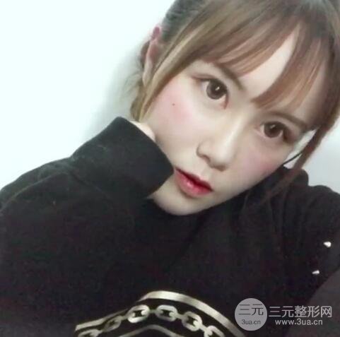 自體脂肪填充全臉基本換臉，改臉型不只是磨骨才能做到！