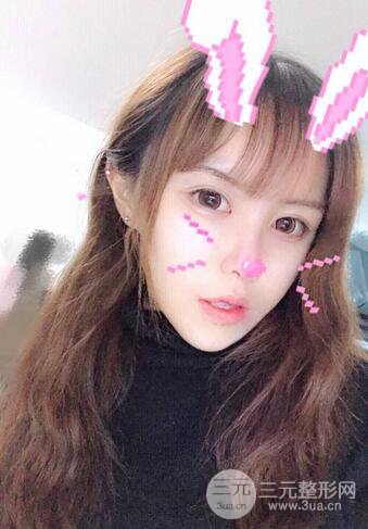 自體脂肪填充全臉基本換臉，改臉型不只是磨骨才能做到！