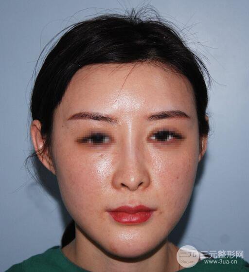 隆鼻失敗修復(fù)