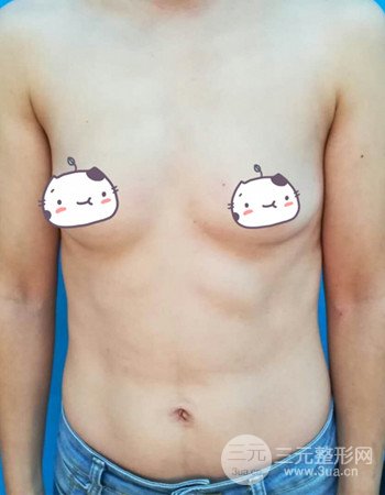 上海假體隆胸真人案例，罩杯從A-到C不是夢(mèng)