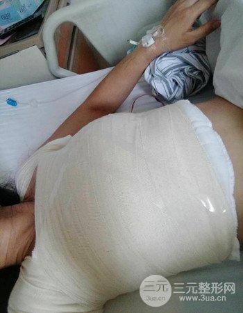 上海假體隆胸真人案例，罩杯從A-到C不是夢(mèng)