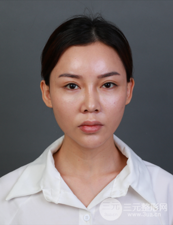 上海隆鼻失敗手術(shù)修復(fù)果超乎想象、前后對(duì)比照片分享