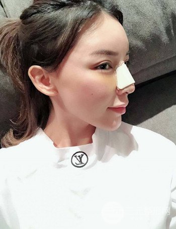 上海隆鼻失敗手術(shù)修復(fù)果超乎想象、前后對(duì)比照片分享