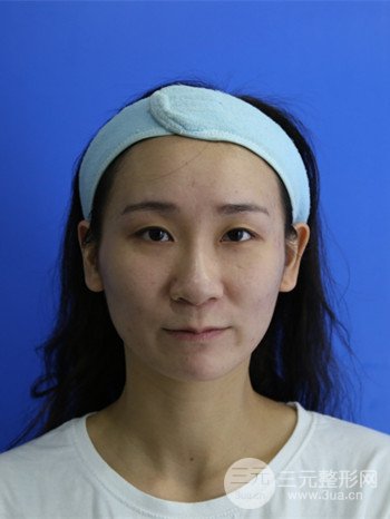 面部埋埋蛋白線.提升改良皮膚松弛，立現(xiàn)小V臉