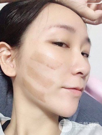 面部埋埋蛋白線.提升改良皮膚松弛，立現(xiàn)小V臉