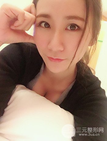 面部埋埋蛋白線.提升改良皮膚松弛，立現(xiàn)小V臉