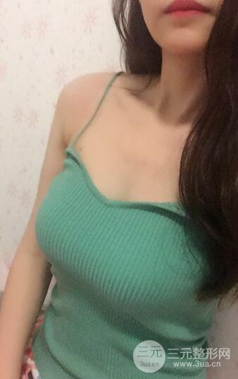 自體脂肪豐胸案例