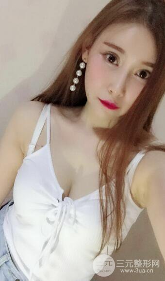 自體脂肪豐胸案例