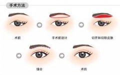 如何避免切眉手術(shù)的后遺癥