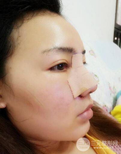 耳軟骨隆鼻全過程及術(shù)后果分享