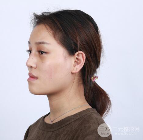 【下頜角+顴骨+下巴】全臉磨骨整形