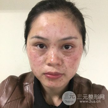 廣州激光祛雀斑果不反彈、恢復(fù)過程圖片分享
