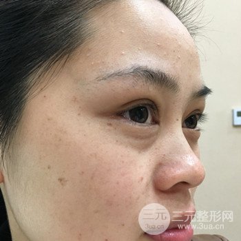 廣州激光祛雀斑果不反彈、恢復(fù)過程圖片分享