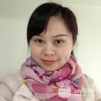 廣州激光祛雀斑果不反彈、恢復(fù)過程圖片分享