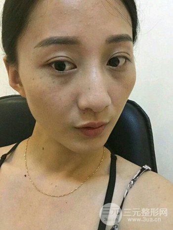 朱彤玥激光祛斑案例、兩個(gè)月果對(duì)比超明X