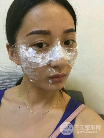 朱彤玥激光祛斑案例、兩個(gè)月果對(duì)比超明X