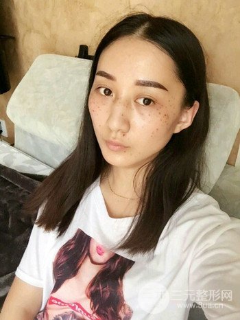 朱彤玥激光祛斑案例、兩個(gè)月果對(duì)比超明X