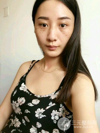 朱彤玥激光祛斑案例、兩個(gè)月果對(duì)比超明X