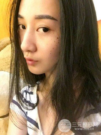 朱彤玥激光祛斑案例、兩個(gè)月果對(duì)比超明X