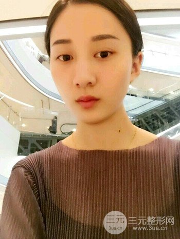 朱彤玥激光祛斑案例、兩個(gè)月果對(duì)比超明X