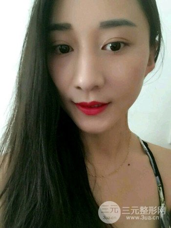 朱彤玥激光祛斑案例、兩個(gè)月果對(duì)比超明X