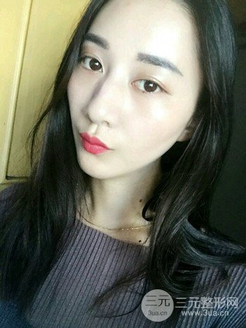 朱彤玥激光祛斑案例、兩個(gè)月果對(duì)比超明X