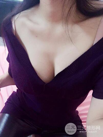 自體脂肪納米豐胸三個(gè)月術(shù)后果展示（附圖）