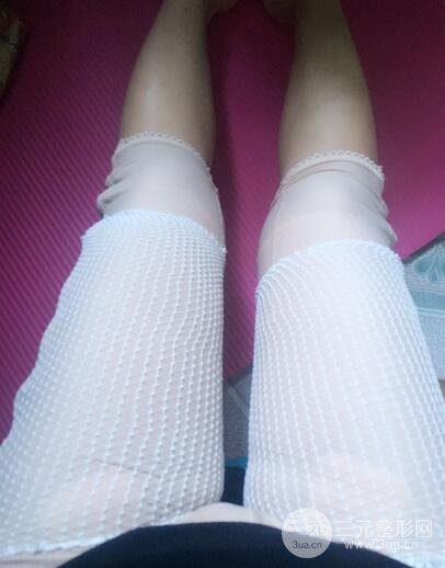 自體脂肪納米豐胸三個(gè)月術(shù)后果展示（附圖）