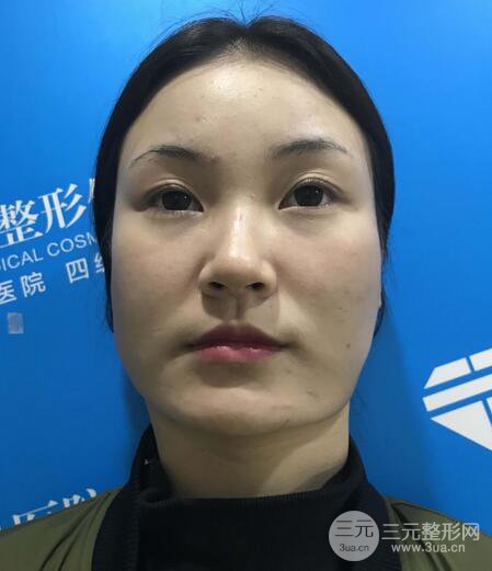 下頜角磨骨整形全過(guò)程分享，附上術(shù)后恢復(fù)照片~