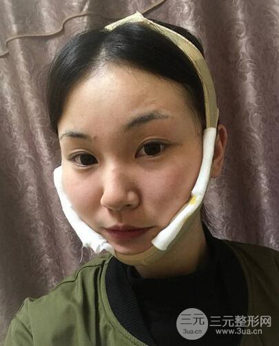 下頜角磨骨整形全過(guò)程分享，附上術(shù)后恢復(fù)照片~