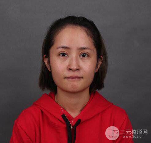 硅膠隆鼻術(shù)前術(shù)后對(duì)比照片分享，走上顏值頂峰