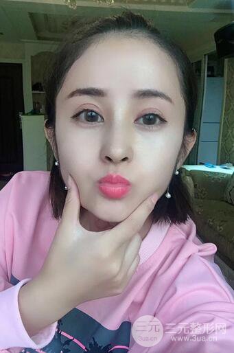 硅膠隆鼻術(shù)前術(shù)后對(duì)比照片分享，走上顏值頂峰