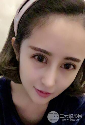 硅膠隆鼻術(shù)前術(shù)后對(duì)比照片分享，走上顏值頂峰