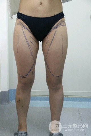 大腿抽脂果好到不行、瘦十厘米不是問題