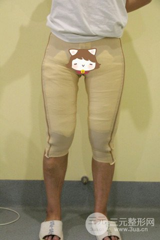 大腿抽脂果好到不行、瘦十厘米不是問題