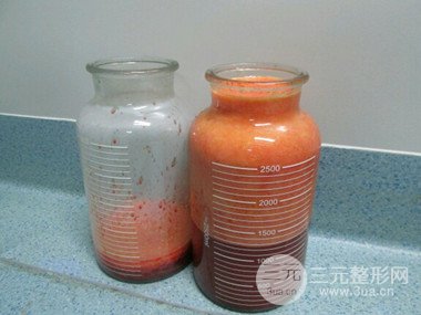 大腿抽脂果好到不行、瘦十厘米不是問題