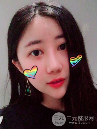 深圳臻希美詳細部自體脂肪填充果對比超明X