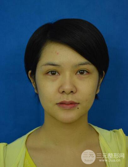 做了隆鼻整形隆鼻之后，短發(fā)女孩也可以性感！