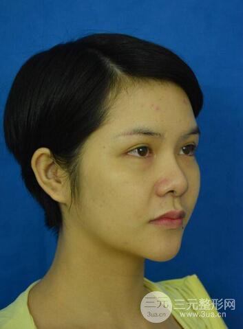 做了隆鼻整形隆鼻之后，短發(fā)女孩也可以性感！
