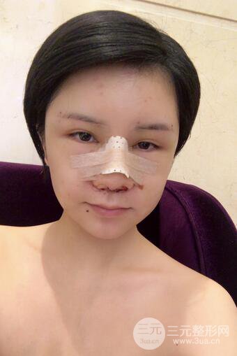 做了隆鼻整形隆鼻之后，短發(fā)女孩也可以性感！