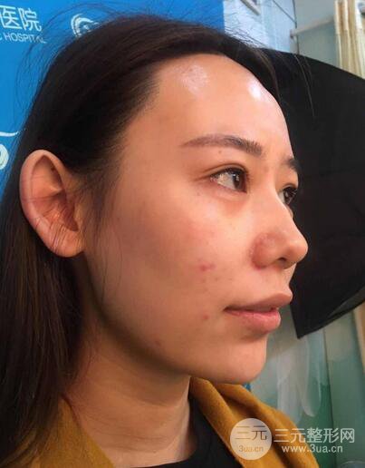 全臉自體脂肪填充，填充不飽滿還可以瘦臉_真人案例